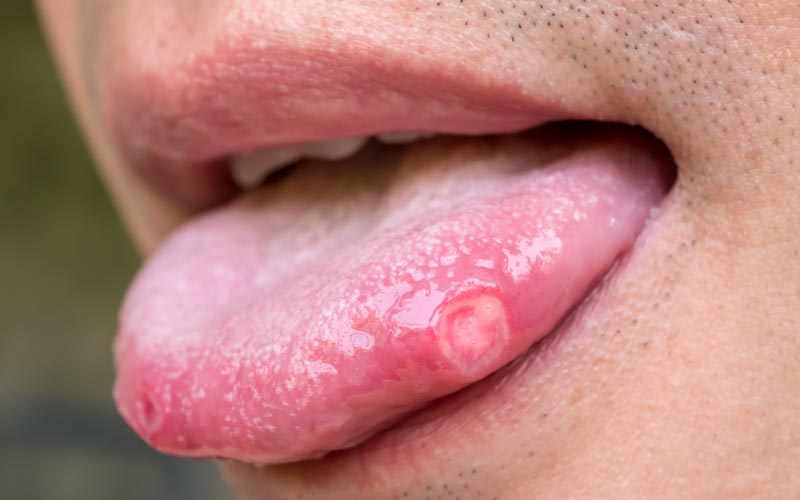 Blister (blæner) i munden: 6 konkrete ting du skal >>