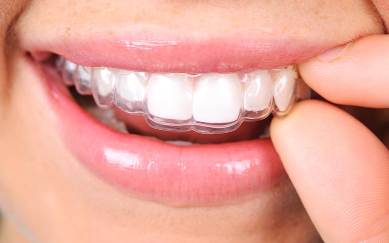 Fremragende Kvadrant greb Tandregulering for voksne - med usynlig tandbøjle | Godt Smil