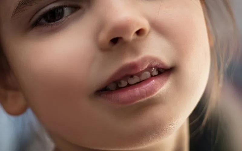 begyndende hul i en tand