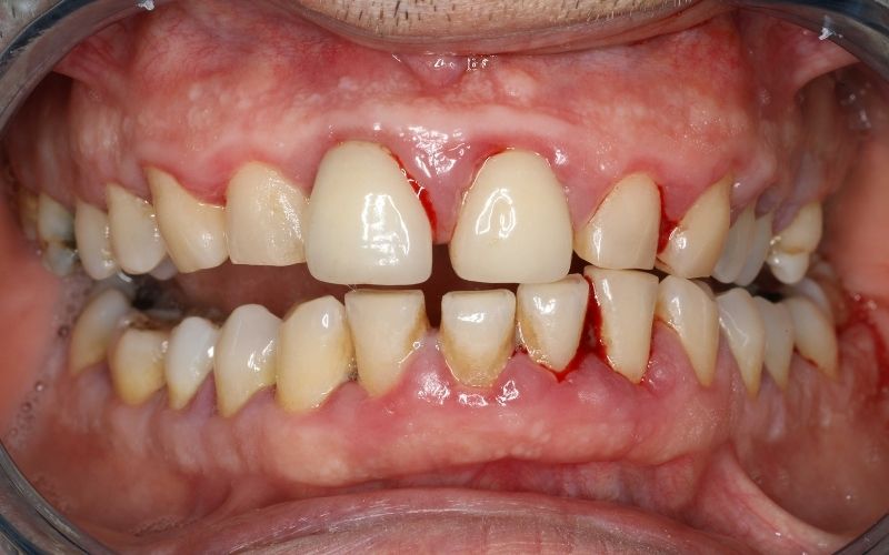 gingivitis