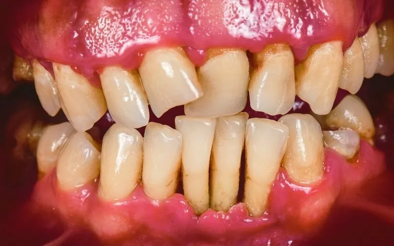 Aggressiv paradentose