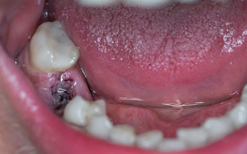 Dårlig smag i munden efter fjernelse af visdomstand