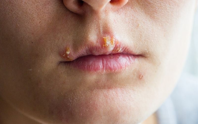 forkølelsessår behandling